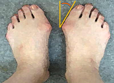 外反母趾の人の足の指